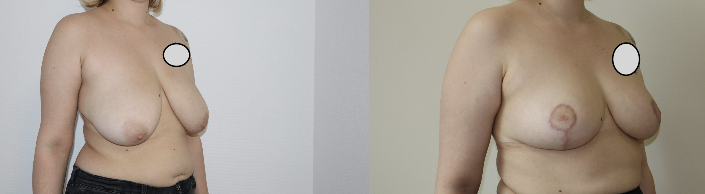 Avant/Après lifting seins et réduction mammaire